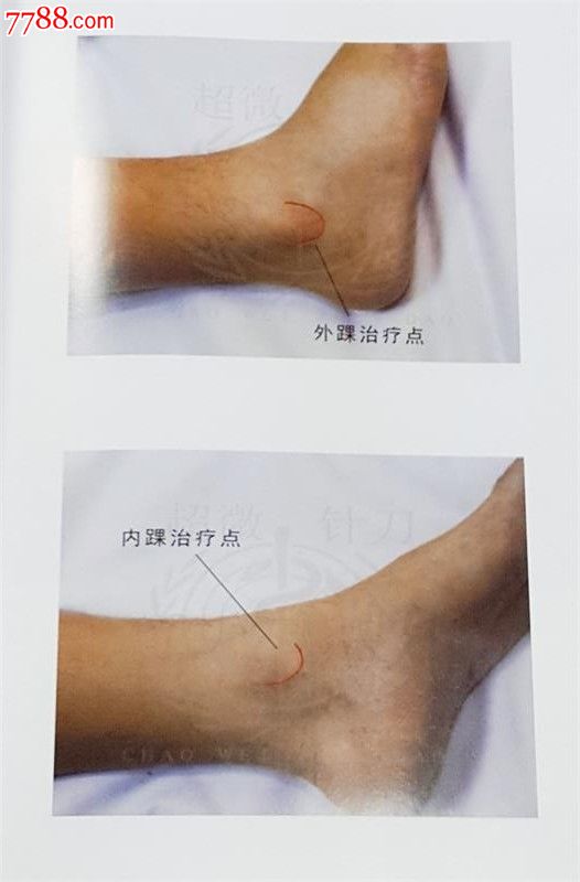 超微针刀疗法第2版:运动医学的浅筋膜松解术胡